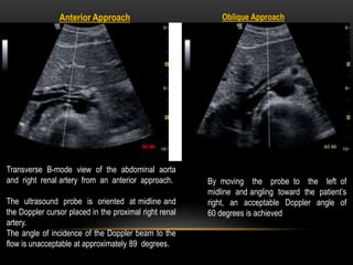Anterior Approach Oblique Approach
Transverse B-mode view of the abdominal aorta
and right renal artery from an anterior approach.
The ultrasound probe is oriented at midline and
the Doppler cursor placed in the proximal right renal
artery.
The angle of incidence of the Doppler beam to the
flow is unacceptable at approximately 89 degrees.
By moving the probe to the left of
midline and angling toward the patient’s
right, an acceptable Doppler angle of
60 degrees is achieved
 