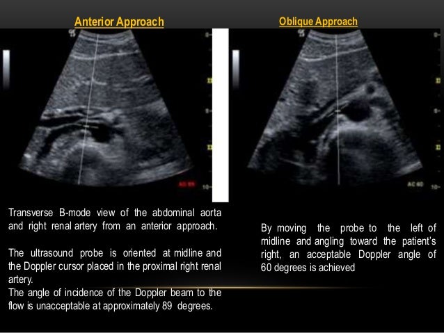 What is renal artery ultrasound?