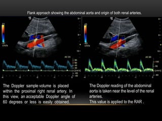 The Doppler sample volume is placed
within the proximal right renal artery. In
this view, an acceptable Doppler angle of
60 degrees or less is easily obtained.
Flank approach showing the abdominal aorta and origin of both renal arteries.
The Doppler reading of the abdominal
aorta is taken near the level of the renal
arteries.
This value is applied to the RAR .
 