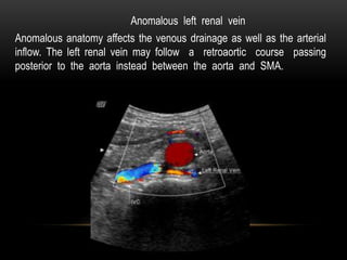 Anomalous anatomy affects the venous drainage as well as the arterial
inflow. The left renal vein may follow a retroaortic course passing
posterior to the aorta instead between the aorta and SMA.
Anomalous left renal vein
 