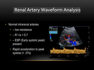 • Normal intrarenal arteries
• – low resistance
• – R I is < 0.7
• – ESP (Early systolic peak)
present
• Rapid acceleration to peak
systole (< .07s)
 