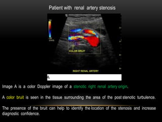 Patient with renal artery stenosis
Image A is a color Doppler image of a stenotic right renal artery origin.
A color bruit is seen in the tissue surrounding the area of the post stenotic turbulence.
The presence of the bruit can help to identify the location of the stenosis and increase
diagnostic confidence.
 