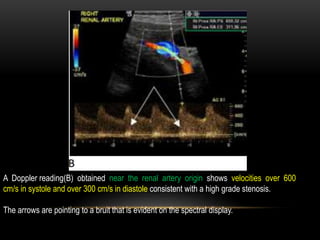 A Doppler reading(B) obtained near the renal artery origin shows velocities over 600
cm/s in systole and over 300 cm/s in diastole consistent with a high grade stenosis.
The arrows are pointing to a bruit that is evident on the spectral display.
 