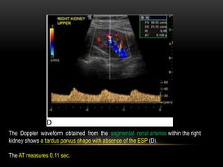 The Doppler waveform obtained from the segmental renal arteries within the right
kidney shows a tardus parvus shape with absence of the ESP (D).
The AT measures 0.11 sec.
 