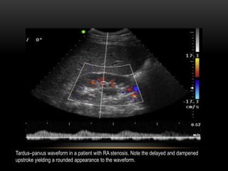 Tardus–parvus waveform in a patient with RA stenosis. Note the delayed and dampened
upstroke yielding a rounded appearance to the waveform.
 