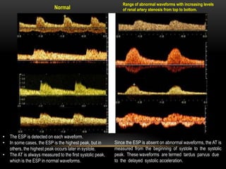 Normal
Range of abnormal waveforms with increasing levels
of renal artery stenosis from top to bottom.
• The ESP is detected on each waveform.
• In some cases, the ESP is the highest peak, but in
others, the highest peak occurs later in systole.
• The AT is always measured to the first systolic peak,
which is the ESP in normal waveforms.
Since the ESP is absent on abnormal waveforms, the AT is
measured from the beginning of systole to the systolic
peak. These waveforms are termed tardus parvus due
to the delayed systolic acceleration.
 