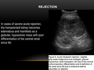 REJECTION
In cases of severe acute rejection,
the transplanted kidney becomes
edematous and manifests as a
globular, hypoechoic mass with poor
differentiation of the central renal
sinus fat.
 