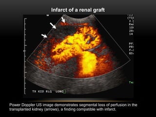 Infarct of a renal graft.
©2005 by Radiological Society of North America
Power Doppler US image demonstrates segmental loss of perfusion in the
transplanted kidney (arrows), a finding compatible with infarct.
 