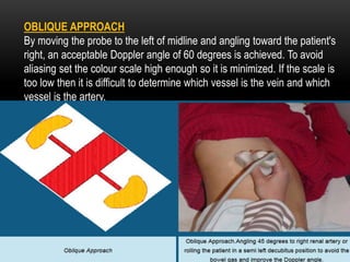 OBLIQUE APPROACH
By moving the probe to the left of midline and angling toward the patient's
right, an acceptable Doppler angle of 60 degrees is achieved. To avoid
aliasing set the colour scale high enough so it is minimized. If the scale is
too low then it is difficult to determine which vessel is the vein and which
vessel is the artery.
 