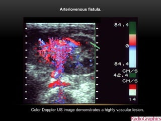 Arteriovenous fistula.
Color Doppler US image demonstrates a highly vascular lesion.
 