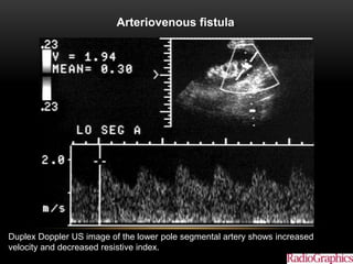 Arteriovenous fistula.
Akbar S A et al. Radiographics 2005;25:1335-1356
©2005 by Radiological Society of North America
Duplex Doppler US image of the lower pole segmental artery shows increased
velocity and decreased resistive index.
 