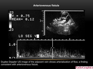 Arteriovenous fistula.
Akbar S A et al. Radiographics 2005;25:1335-1356
©2005 by Radiological Society of North America
Duplex Doppler US image of the adjacent vein shows arterialization of flow, a finding
consistent with arteriovenous fistula.
 
