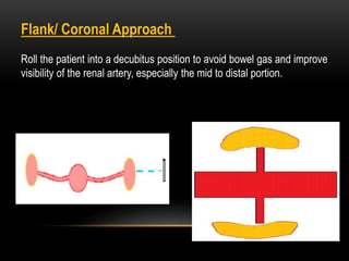 Flank/ Coronal Approach
Roll the patient into a decubitus position to avoid bowel gas and improve
visibility of the renal artery, especially the mid to distal portion.
 