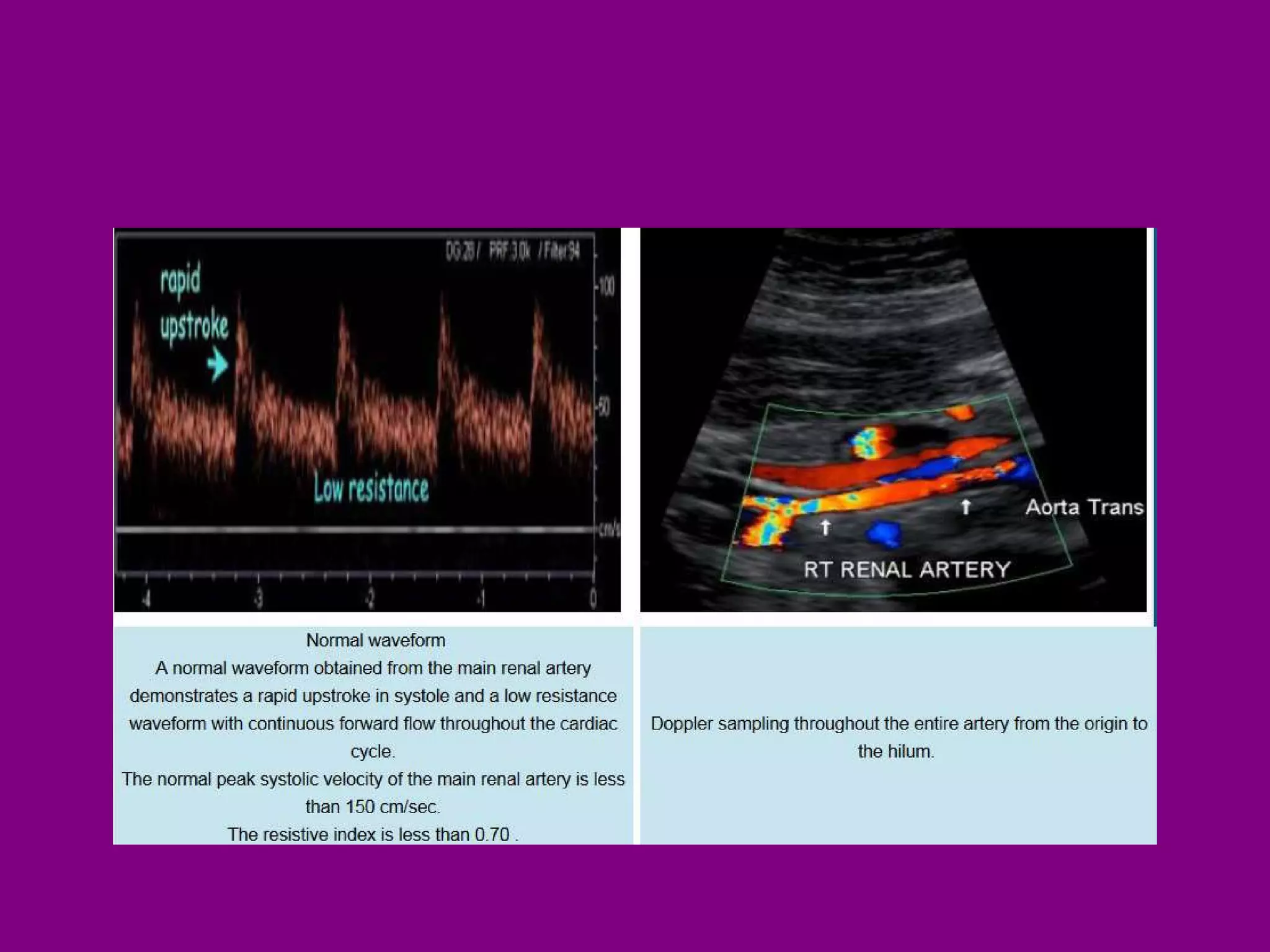 Renal doppler ultrasound | PPT