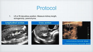 Protocol
1. Lft or Rt decubitus position. Measure kidney length,
echogenicity, parenchyma.
 