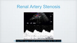 Renal Artery Stenosis
Normal PSV range in adult renal arteries is 60 to 100 cm/sec.
 