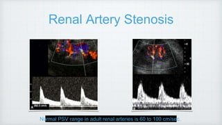 Renal Artery Stenosis
Normal PSV range in adult renal arteries is 60 to 100 cm/sec.
 