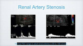 Renal Artery Stenosis
Normal PSV range in adult renal arteries is 60 to 100 cm/sec.
 