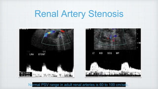 Renal Artery Stenosis
Normal PSV range in adult renal arteries is 60 to 100 cm/sec.
 