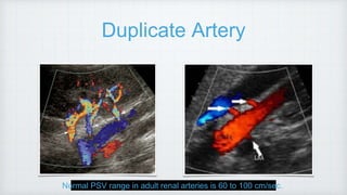 Duplicate Artery
Normal PSV range in adult renal arteries is 60 to 100 cm/sec.
 