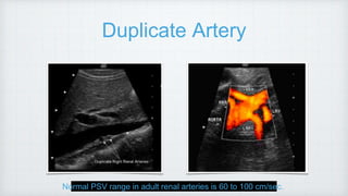 Duplicate Artery
Normal PSV range in adult renal arteries is 60 to 100 cm/sec.
 