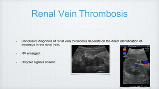 Renal Vein Thrombosis
Conclusive diagnosis of renal vein thrombosis depends on the direct identification of
thrombus in the renal vein.
RV enlarged.
Doppler signals absent.
 