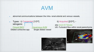 AVM
abnormal communications between the intra- renal arterial and venous vessels.
Types : i) Congenital [1/3rd] ii) Acquired [2/3rd]. -
iatrogenic
Cirsoid [MC] Cavernous AVM
Dilated corkscrew app Single dilated vessel
aka renal AV fistulas
US -Turbulent flow within renal parenchyma
 