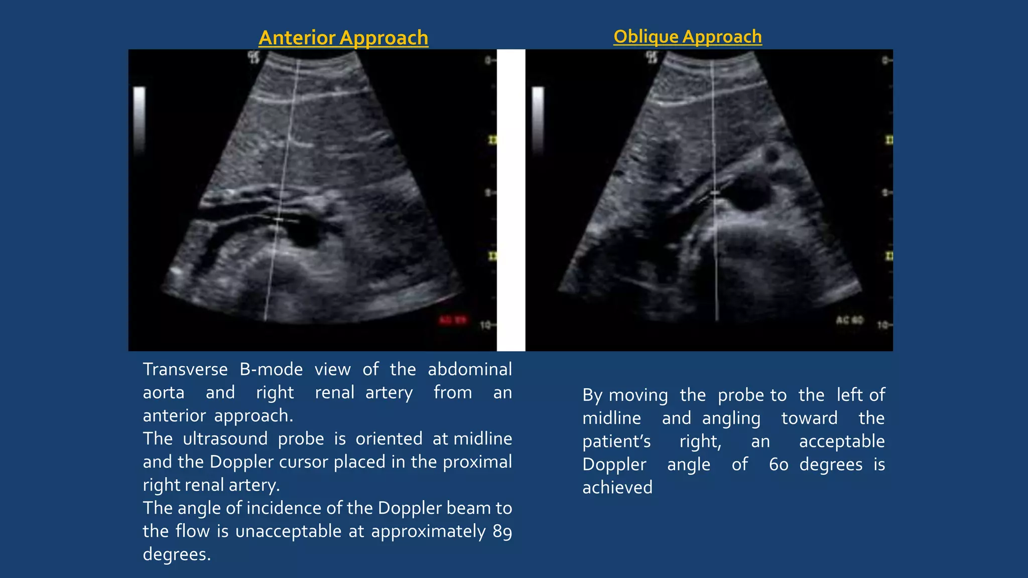 Anterior Approach Oblique Approach
Transverse B-mode view of the abdominal
aorta and right renal artery from an
anterior approach.
The ultrasound probe is oriented at midline
and the Doppler cursor placed in the proximal
right renal artery.
The angle of incidence of the Doppler beam to
the flow is unacceptable at approximately 89
degrees.
By moving the probe to the left of
midline and angling toward the
patient’s right, an acceptable
Doppler angle of 60 degrees is
achieved
 