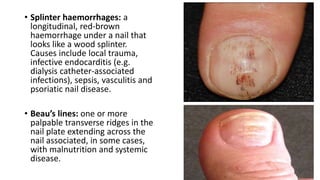 • Splinter haemorrhages: a
longitudinal, red-brown
haemorrhage under a nail that
looks like a wood splinter.
Causes include local trauma,
infective endocarditis (e.g.
dialysis catheter-associated
infections), sepsis, vasculitis and
psoriatic nail disease.
• Beau’s lines: one or more
palpable transverse ridges in the
nail plate extending across the
nail associated, in some cases,
with malnutrition and systemic
disease.
 