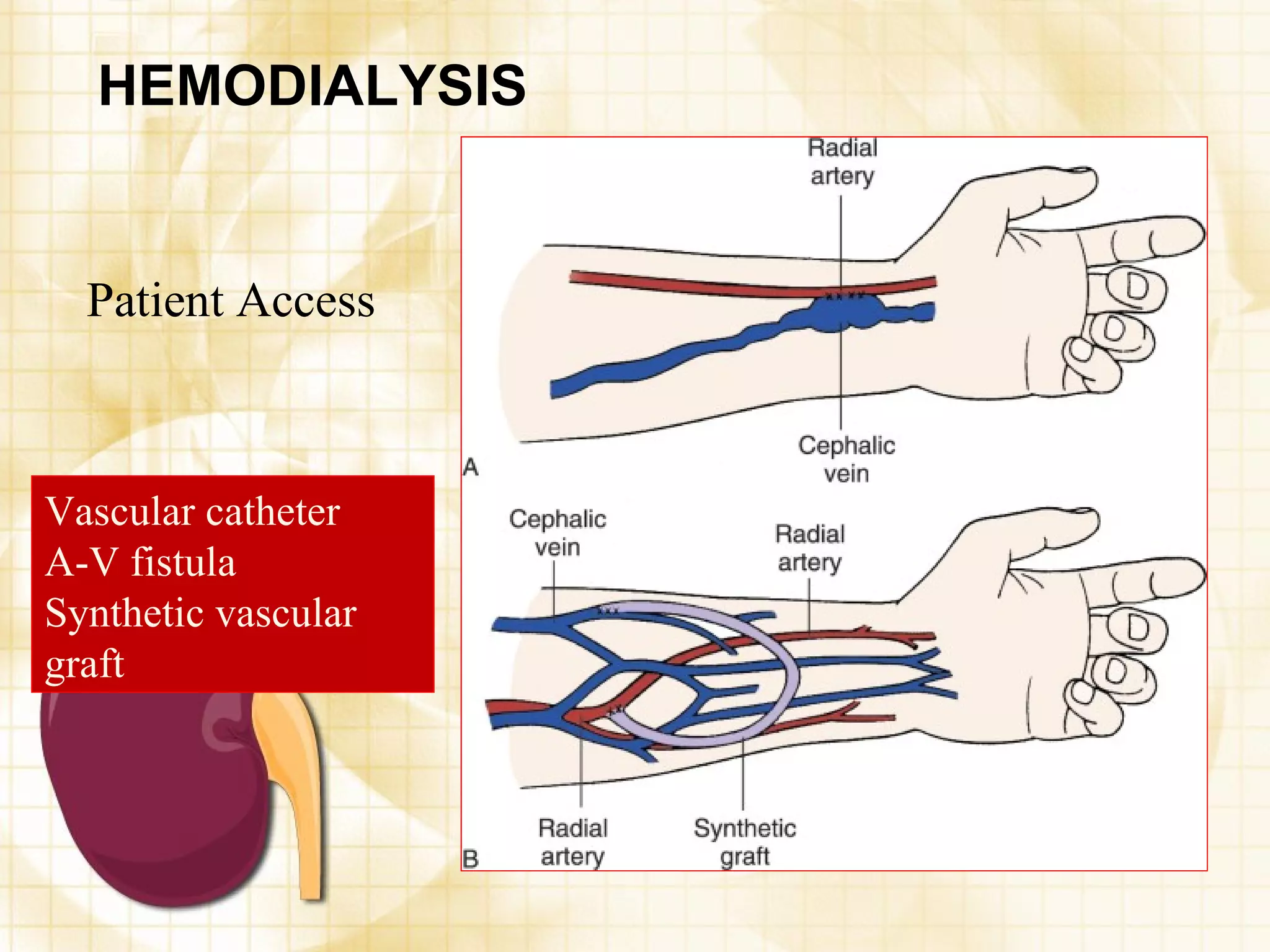HEMODIALYSIS Patient Access Vascular catheter  A-V fistula  Synthetic vascular graft 