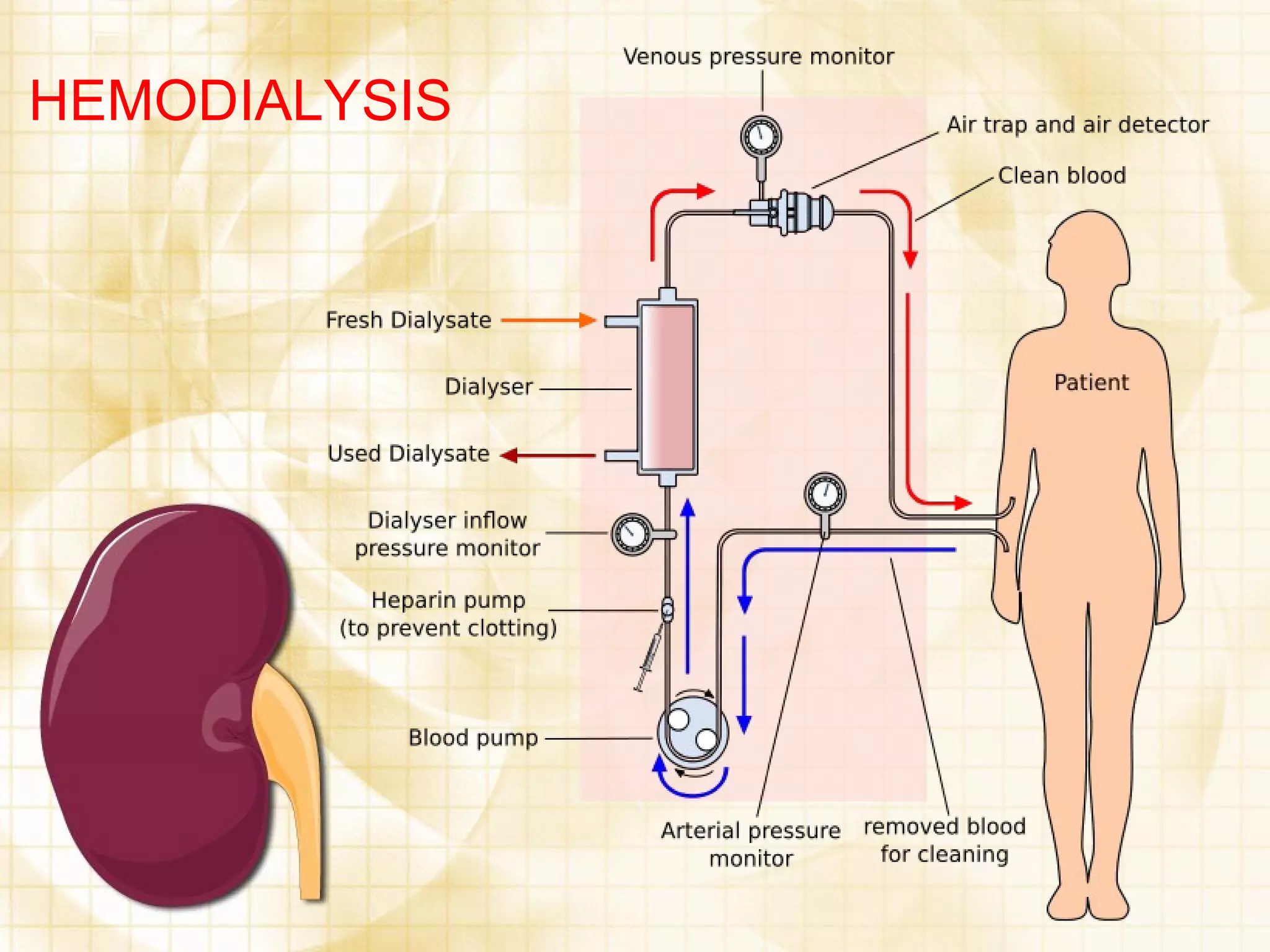 HEMODIALYSIS 