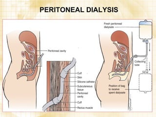 PERITONEAL DIALYSIS 