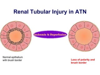 Renal Tubular Injury in ATN Loss of polarity and brush border   Normal epithelium with brush border  