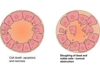Cell death -apoptosis and necrosis  Sloughing of dead and viable cells - luminal obstruction   