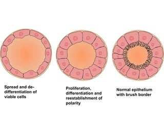 Spread and de-differentiation of viable cells   Proliferation, differentiation and reestablishment of polarity Normal epithelium with brush border   