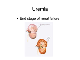 Uremia End stage of renal failure 