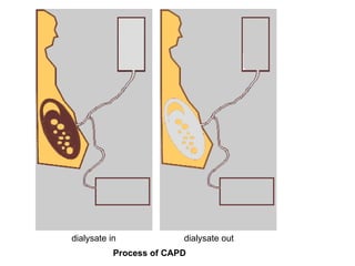 dialysate out  dialysate in  Process of CAPD    