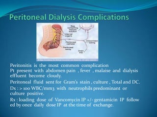 Peritoneal Dialysis ComplicationsPeritonitis  is  the  most  common  complicationPt  present  with  abdomen pain  , fever  , malaise  and  dialysis effluent  become  cloudy.Peritoneal  fluid  sent for  Gram’s  stain , culture , Total and DC.Dx : > 100 WBC/mm3  with  neutrophils predominant  or  culture  positive.Rx : loading  dose  of  Vancomycin IP +/- gentamicin  IP  follow ed by once  daily  dose IP  at the time of  exchange.