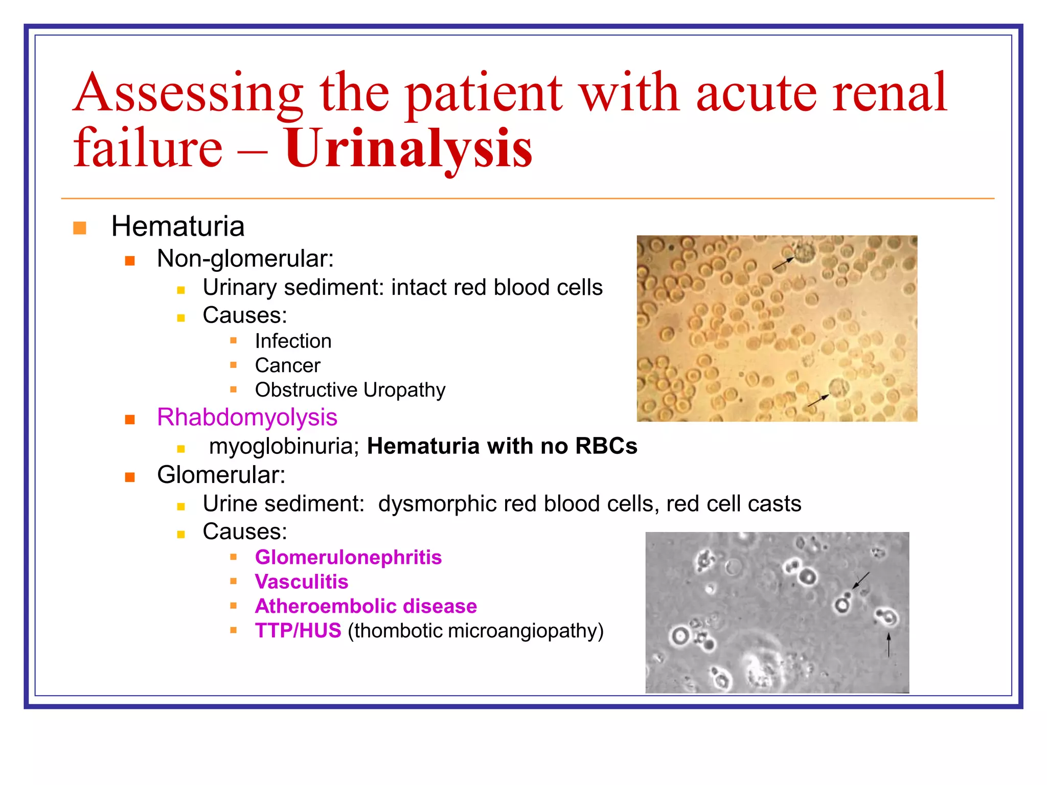 Assessing the patient with acute renal
failure – Urinalysis
 Hematuria
 Non-glomerular:
 Urinary sediment: intact red blood cells
 Causes:
 Infection
 Cancer
 Obstructive Uropathy
 Rhabdomyolysis
 myoglobinuria; Hematuria with no RBCs
 Glomerular:
 Urine sediment: dysmorphic red blood cells, red cell casts
 Causes:
 Glomerulonephritis
 Vasculitis
 Atheroembolic disease
 TTP/HUS (thombotic microangiopathy)
 