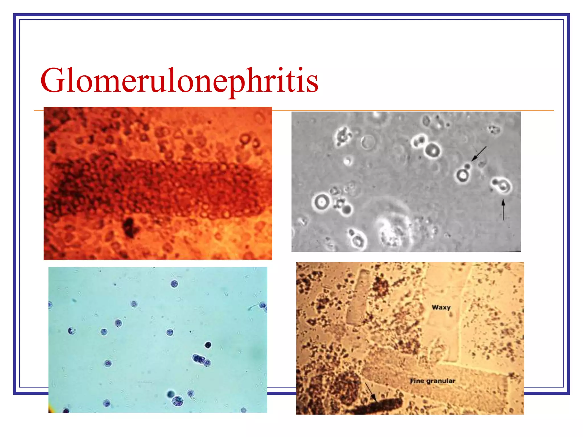 Glomerulonephritis
 