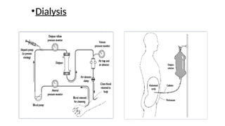 •Dialysis
 