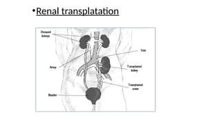 •Renal transplatation
 