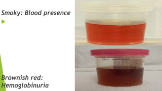 Smoky: Blood presence

Brownish red:
Hemoglobinuria
 