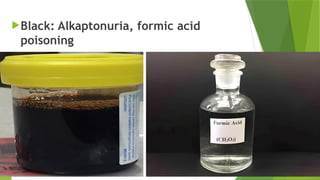 Black: Alkaptonuria, formic acid
poisoning
 