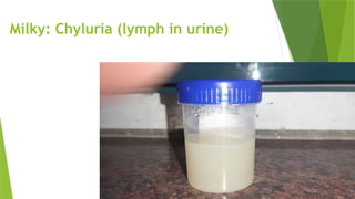 Milky: Chyluria (lymph in urine)
 
