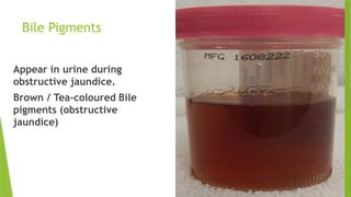 Bile Pigments
Appear in urine during
obstructive jaundice.
Brown / Tea-coloured Bile
pigments (obstructive
jaundice)
 