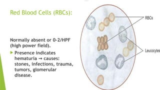 Red Blood Cells (RBCs):
Normally absent or 0–2/HPF
(high power field).
 Presence indicates
hematuria causes:
→
stones, infections, trauma,
tumors, glomerular
disease.
 