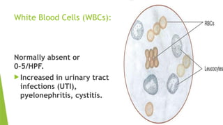 White Blood Cells (WBCs):
Normally absent or
0–5/HPF.
 Increased in urinary tract
infections (UTI),
pyelonephritis, cystitis.
 