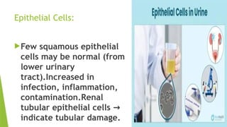 Epithelial Cells:
Few squamous epithelial
cells may be normal (from
lower urinary
tract).Increased in
infection, inflammation,
contamination.Renal
tubular epithelial cells →
indicate tubular damage.
 
