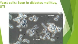 Yeast cells: Seen in diabetes mellitus,
UTI
 